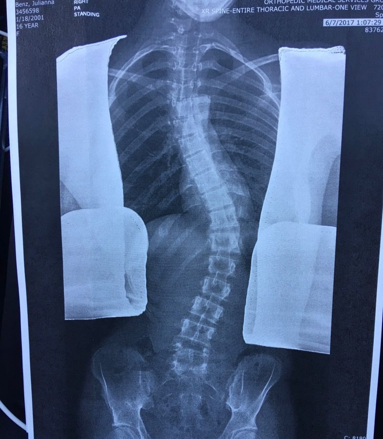 Living+with+Scoliosis